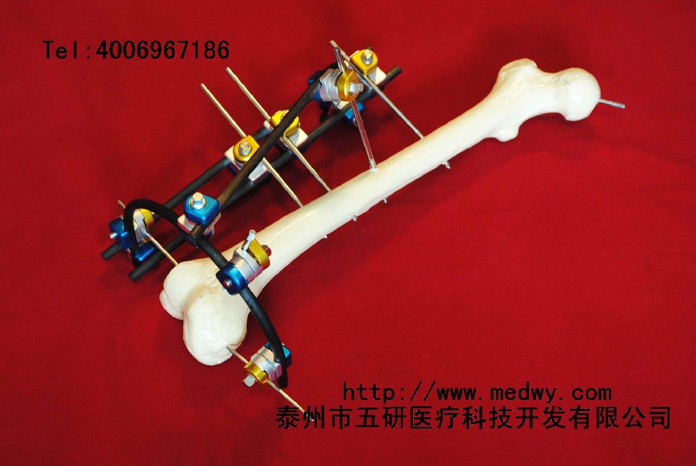 骨折、關(guān)節(jié)炎與四肢畸形患者福音